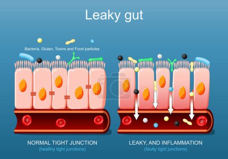 Illustration for Leaky gut. Close-up of cells of a intestinal epithelium. Difference between Healthy cells, and inflamed intestinal cells. Comparison normal tissue of the gastrointestinal tract, and Intestinal permeability. Vector poster. Isometric Flat illustration. - Royalty Free Image