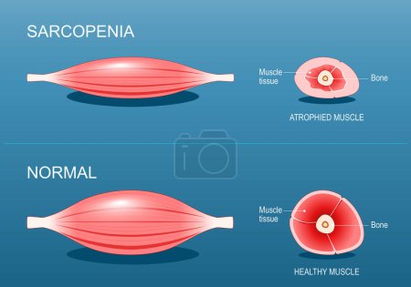 Sarcopenia. Age-related muscle atrophy. Comparison and Difference between normal muscle fiber and sarcopenia. Cross section of biceps muscle of Young active person, and Old passive human. Vector poster. Isometric Flat illustration.