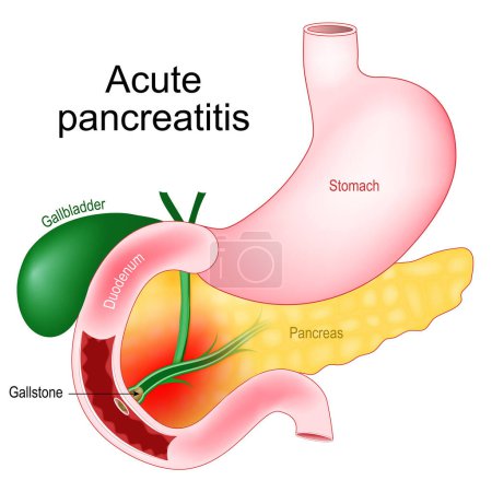 Pancreatitis aguda. Inflamación del páncreas. Imagen realista de los órganos abdominales vesícula biliar, duodeno, estómago y páncreas. Primer plano de un cálculo biliar que bloquea el conducto pancreático y la papila duodenal