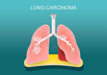 Lung carcinoma. Lung cancer. Tumors metastasize, spreading to other parts of the body. Vector poster. Isometric Flat illustration.