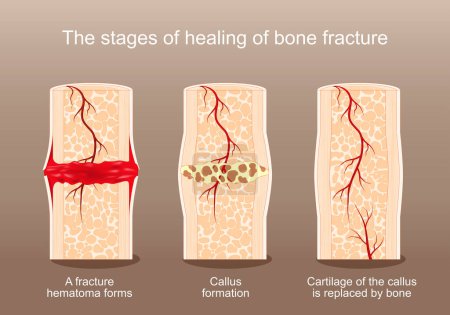 Las etapas de curación de la fractura ósea. Desde hematoma y callo hasta cartílago que reemplazó por hueso. Cartel vectorial. Ilustración plana isométrica