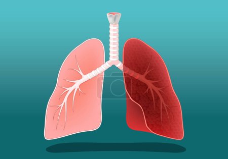 Human lungs. Healthy and diseased, inflamed or like lungs of a smoker, or a person with cancer. Vector poster. Isometric Flat illustration.