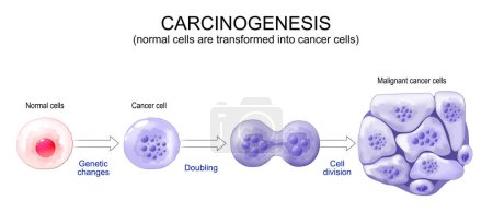 Krebsentwicklung. Normale Zellen werden in Krebs umgewandelt. Karzinogenese von genetischen Mutationen in gesunden Zellen zu bösartigen Krebszellen. Mutagenese, Onkogenese oder Tumorigenese. Tumorbildung. Vektorillustration. 