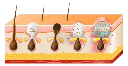 Types of acne pimples. Whiteheads, Blackheads, Papules and Pustules. Cross section of layers of human skin. Close-up of a Sebaceous glands with Sebum and Skin microbiome. Vector illustration