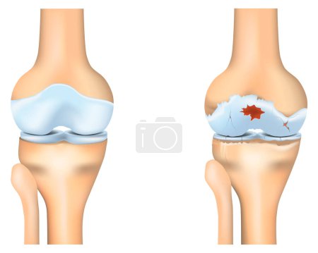 Knee osteoarthritis. Joint degeneration. Vector illustration.