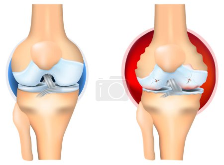 Arthrite rhumatoïde de l'articulation du genou. La PR est un type d'arthrite inflammatoire. Maladie auto-immune. Arthrite érosive. Illustration vectorielle.