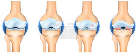Stadien der Arthrose. Anatomie des Kniegelenks Vektor Illustration