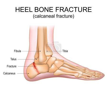 Heel bone fracture. Calcaneal fracture. Foot injury. Vector illustration.