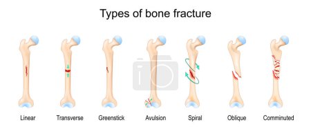 Types of bone fracture. Femur bone. Vector illustration.