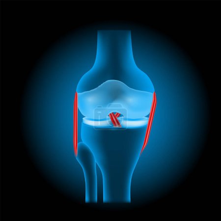 ligament injuries to the knee. Realistic transparent blue human knee joint with glowing effect on dark background. vector illustration like X-ray image for healthcare design. Knee trauma. Sports injuries. Injury prevention