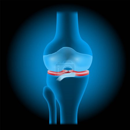 Knee meniscus injuries. Knee joint anatomy. Realistic transparent blue joint with glowing effect on dark background. vector illustration like X-ray image for healthcare design. Meniscal tear. Knee trauma. Sports injuries. Injury prevention