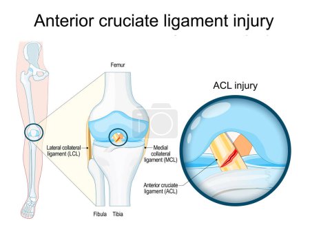 Lesión de ligamento cruzado anterior. Primer plano de una articulación de rodilla humana. Trauma de rodilla como desgarro o esguince del ligamento cruzado anterior. Lesiones deportivas. Ilustración vectorial