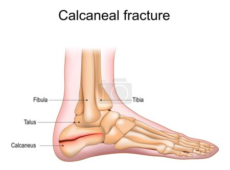 Calcaneal fracture. Trauma of Heel bone. Foot injury. Anatomy of foot joints. Vector illustration