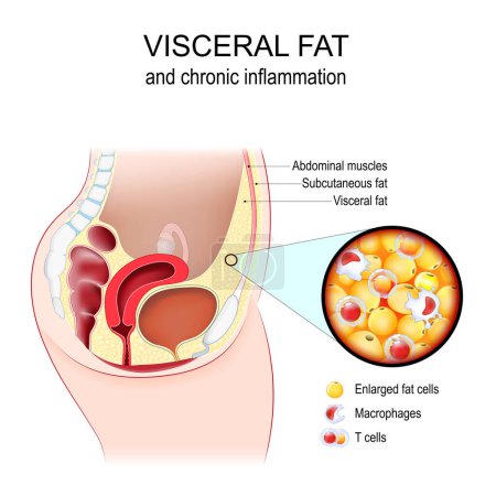 Visceral fat and Chronic inflammation. Cross section of female abdomen with Abdominal muscle, Subcutaneous and Visceral fat. Close-up of  Adipose tissue with T cells, macrophages, and Enlarged fat cells. Vector illustration. Metabolic syndrome