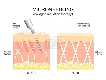Procedimiento de microneedling. Corte transversal de una piel humana antes y después de la terapia de inducción de colágeno. Rejuvenecimiento de la piel. Tratamiento anti-envejecimiento. Quirúrgico para eliminar arrugas, cicatrices, estiramientos, marcas, pigmentación. Perforación repetida de la piel con diminutas, 