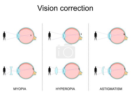 Vision defects. Myopia, Hyperopia, Astigmatism. Vision Correction by glasses. Refractive errors. Cross section of human eye. Close-up of a macula, retina, sclera, and fovea. 
