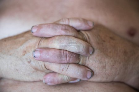 Téléchargez les photos : Mains croisées avec des ongles sales sur le ventre d'un homme obèse - en image libre de droit