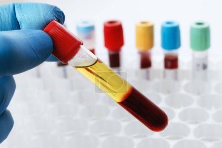 Photo for Blood drawn from a patient with Serum separate in the chemistry laboratory. Lab technician holding a test tube of blood sample after being centrifuged - Royalty Free Image
