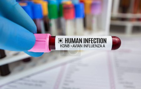 Photo for Technician with Blood collection with positive analysis for Bird Flu disease. Doctor holding blood tube test with Human infection for Avian influenza A H3N8 - Royalty Free Image