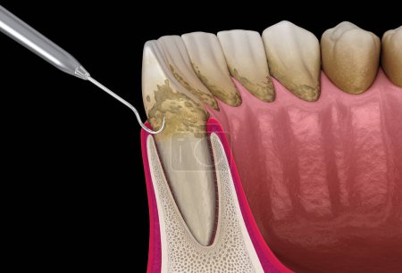 Photo for Oral hygiene: Scaling and root planing (conventional periodontal therapy). Medically accurate 3D illustration of human teeth treatment - Royalty Free Image