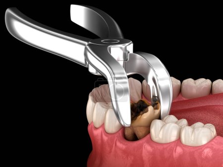 Extracción del diente molar dañado por caries. Ilustración 3D de dientes médicamente precisos.