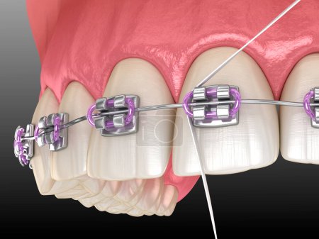 Téléchargez les photos : Procédé de nettoyage des appareils dentaires par fil dentaire. Illustration 3D médicalement précise de l'hygiène buccodentaire. - en image libre de droit