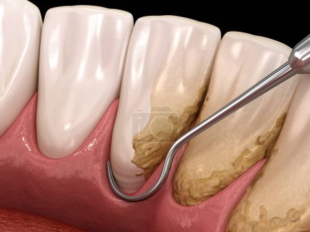 Higiene oral: Escalado y cepillado radicular (terapia periodontal convencional). Ilustración 3D médicamente precisa del tratamiento de dientes humanos