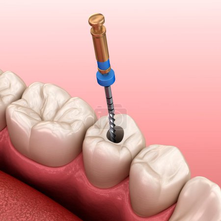 Téléchargez les photos : Processus de traitement endodontique des canaux radiculaires. Illustration 3D dentaire médicalement précise. - en image libre de droit