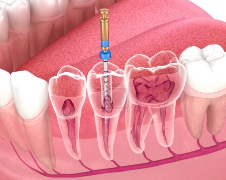 Tratamiento endodóntico del conducto radicular. Ilustración 3D de dientes médicamente precisos.