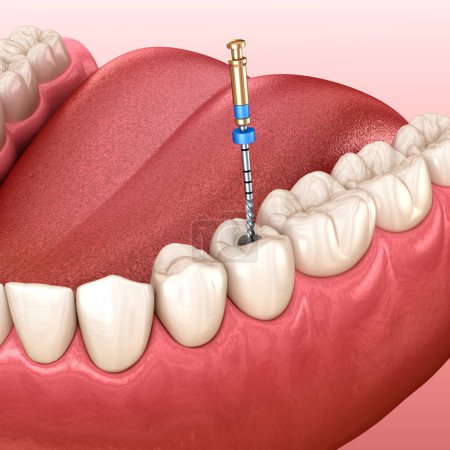 Endodontische Wurzelbehandlung. Medizinisch korrekte 3D-Darstellung der Zähne.