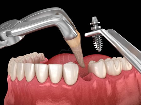 Foto de Extracción e implante, cirugía inmediata compleja. Ilustración 3D médicamente precisa del tratamiento dental - Imagen libre de derechos