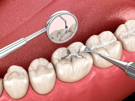 Téléchargez les photos : Restauration des fissures dentaires molaires avec remplissage. Illustration 3D dentaire médicalement précise. - en image libre de droit