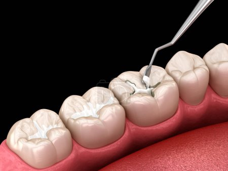 Téléchargez les photos : Restauration des fissures dentaires molaires avec remplissage. Illustration 3D dentaire médicalement précise. - en image libre de droit