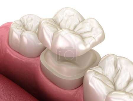 Fijación de corona de cerámica onlay sobre diente. Ilustración 3D médicamente precisa del tratamiento de dientes humanos
