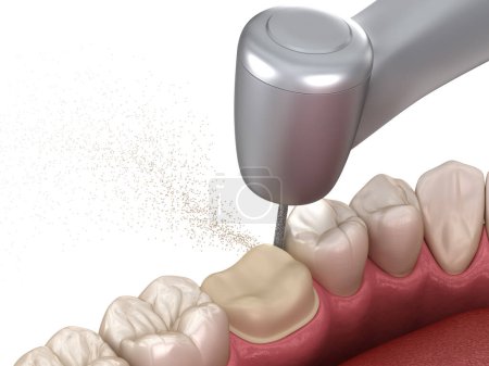 Prämolare Präparation für die Platzierung der Zahnkrone. medizinisch korrekte 3D-Illustration