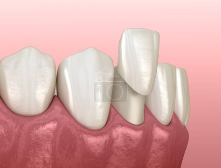 Procedimiento de colocación de chapa. Ilustración 3D de dientes médicamente precisos