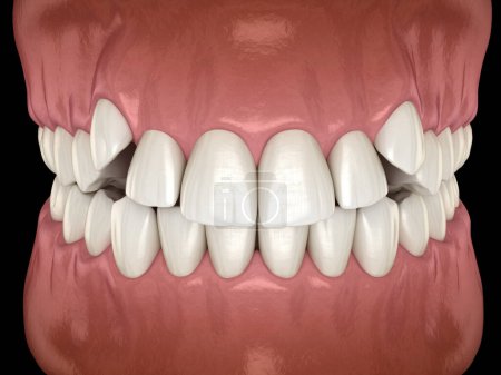 Foto de Incisivos afectados, dientes superpoblados. Ilustración 3D médicamente precisa de oclusión dental anormal - Imagen libre de derechos