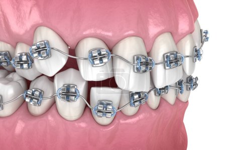 Anomale Zahnstellung und Korrektur mit Metallspangen Tretament. Medizinisch korrekte zahnärztliche 3D-Illustration