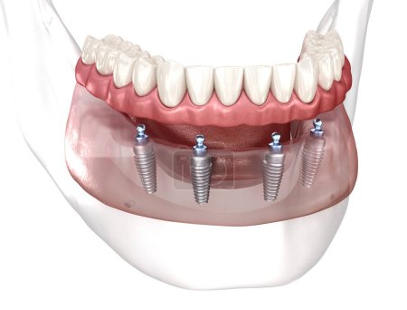 Téléchargez les photos : Prothèse mandibulaire amovible Tout sur 4 système soutenu par des implants. Illustration 3D médicalement précise du concept des dents et prothèses humaines - en image libre de droit