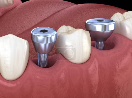 Cover screw - temporary implant abutment. Medically accurate 3D illustration of human teeth and dentures concept
