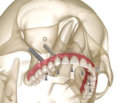 Foto de Prótesis maxilar apoyada por implantes cigomáticos. Ilustración 3D médicamente precisa de dientes humanos y prótesis dentales - Imagen libre de derechos