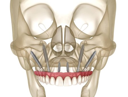 Kieferprothese, die durch Jochbeinimplantate unterstützt wird. Medizinisch genaue 3D-Darstellung menschlicher Zähne und Prothesen