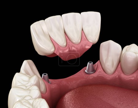Foto de Puente dentario frontal soportado por implantes. Animación 3D médicamente precisa del concepto dental - Imagen libre de derechos