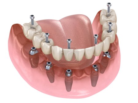 Unterkieferprothese mit Zahnfleisch Alles auf 6 System, das durch Implantate unterstützt wird. Medizinisch genaue 3D-Abbildung des Konzepts menschlicher Zähne und Prothesen
