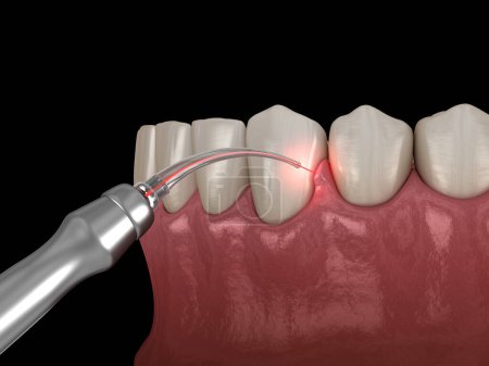 Zahnfleischkorrektur mit Laser. Medizinisch korrekte 3D-Darstellung der Zähne