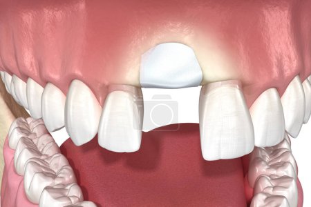 Augmentation Surgery - Adding bone after tooth extraction. 3D illustration