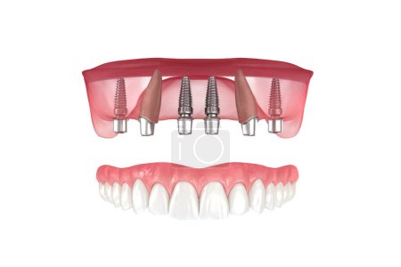 Téléchargez les photos : Prothèse maxillaire soutenue par 2 dents et 4 implants. Illustration 3D médicalement précise - en image libre de droit