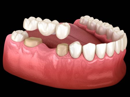 Photo for Dental bridge of 3 teeth over molar and premolar. Dental 3D illustration - Royalty Free Image