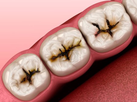 Téléchargez les photos : Dents molaires endommagées par la carie. Illustration 3D dentaire - en image libre de droit