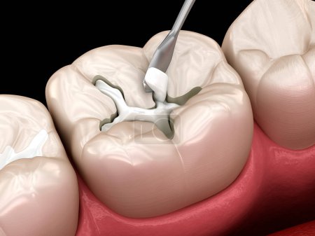 Restauration des dents cariées avec remplissage composite. Illustration 3D dentaire